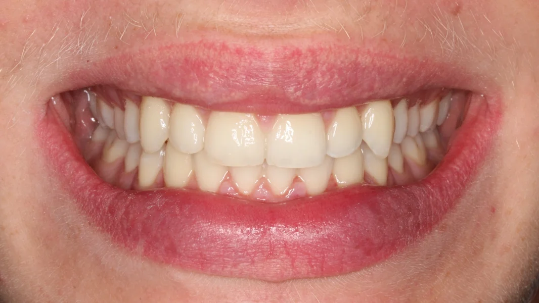Invisalign metamorfoza