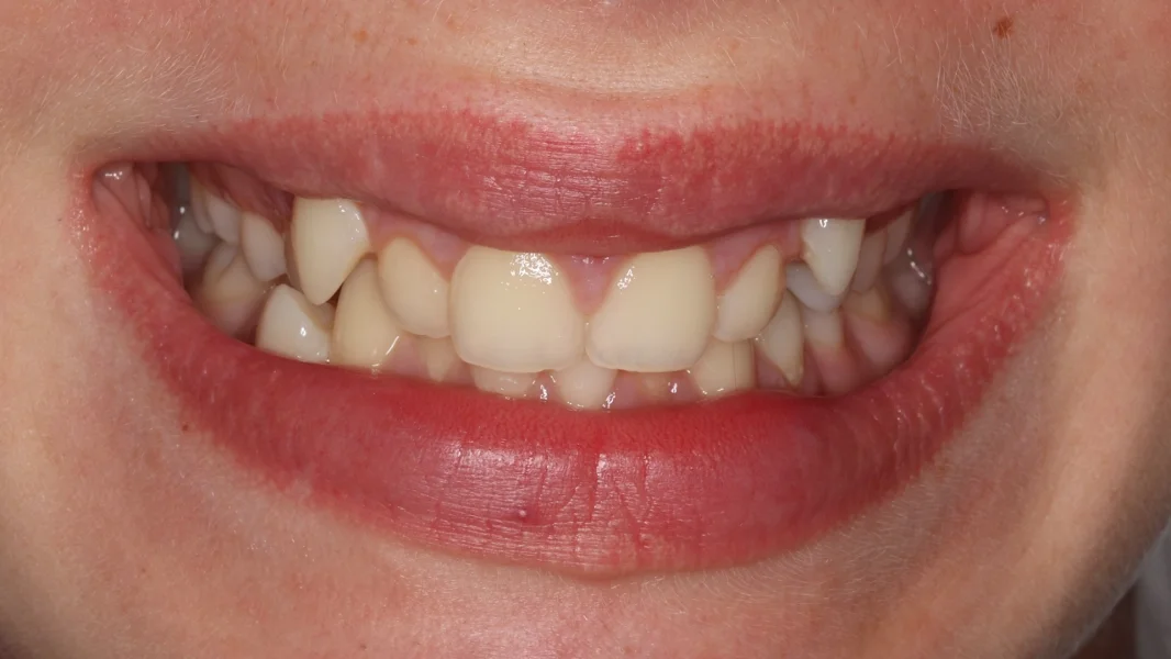 Invisalign metamorfoza