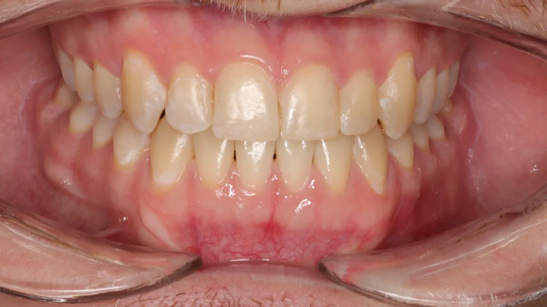 Invisalign metamorfoza