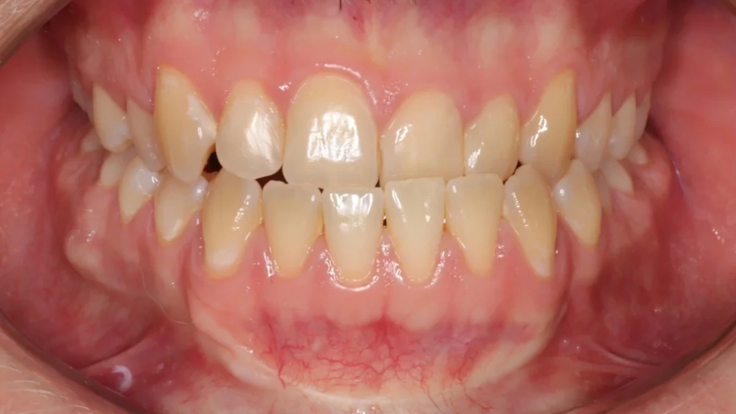 Invisalign metamorfoza