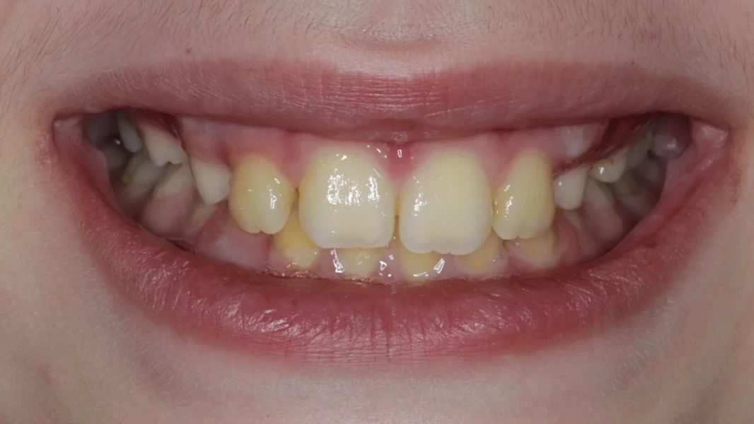 Invisalign metamorfoza