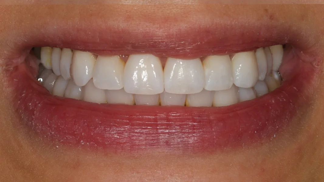 Invisalign metamorfoza