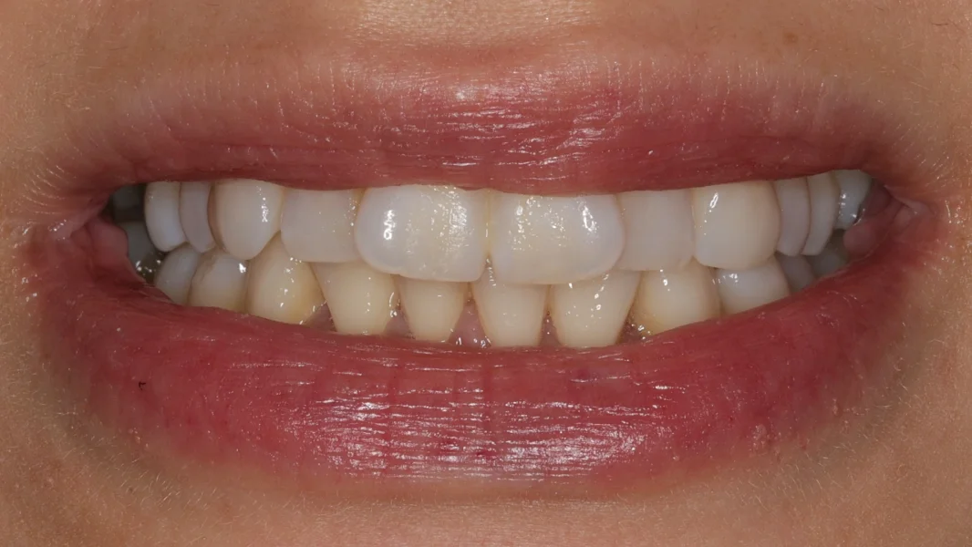 Invisalign metamorfoza